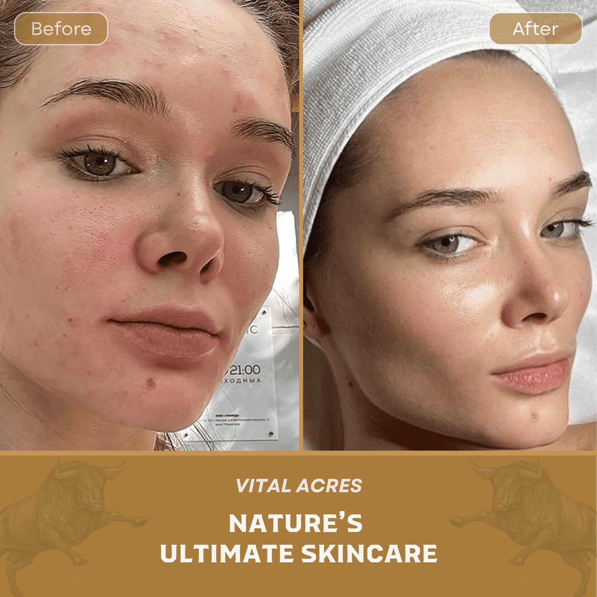 Before and after using Tallow Balm – natural transformation with grass-fed beef tallow moisturizer for acne-prone and sensitive skin
